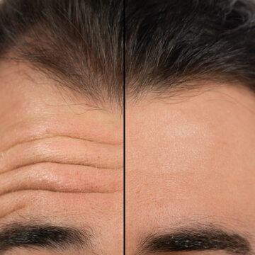 face of a man before and after a cosmetic treatment to smooth expression lines in forehead. Concept of anti-aging and rejuvenation cosmetics on forehead wrinkles